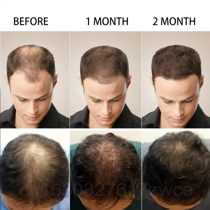 Snelle Haargroei Mannen Vrouwe - Biotin Hair Growth recensie en prijs